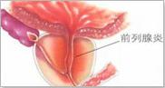 石河子治了前列腺炎一般需要多久