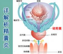 泌尿医生 解析精囊炎