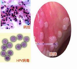 尖锐湿疣有什么症状