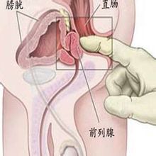 前列腺囊肿患者日常注意