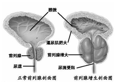 苏州治疗前列腺炎好的医院,前列腺增生?