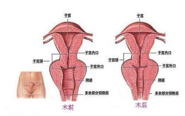 阴道松弛的危害