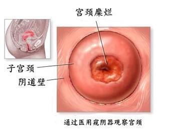 苏州治疗宫颈糜烂东吴 