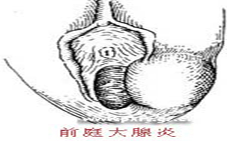 苏州妇科,前庭大腺如何治疗