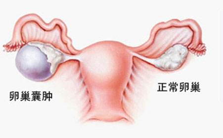 苏州口碑好的妇科医院_卵巢囊肿需要治疗吗