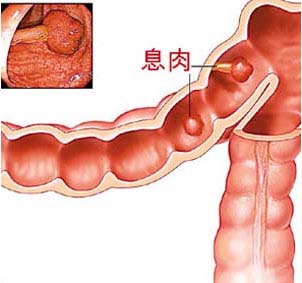 结肠息肉