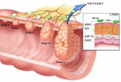 直肠息肉的原因是什么