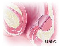 肛窦炎的发病原因是什么