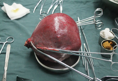 重达6.5斤的肌瘤即使在医学领域也实属罕见