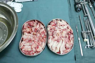 东吴中西医结合医院小创伤妇科案例照片