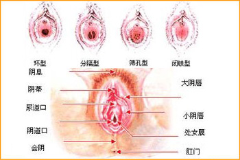 女性处女膜示意图