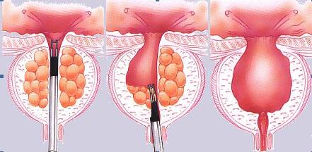 苏州治疗前列腺增生医院
