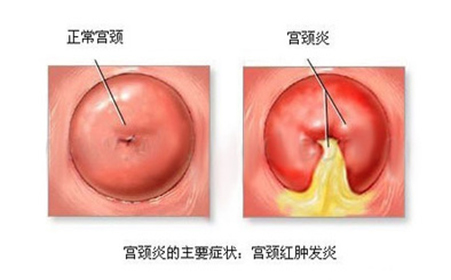 苏州治疗宫颈炎医院