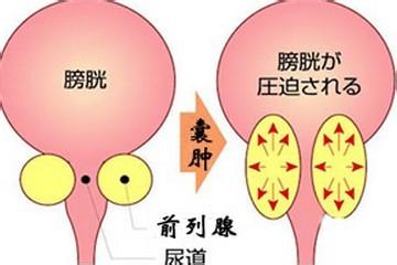 苏州治疗前列腺囊肿医院