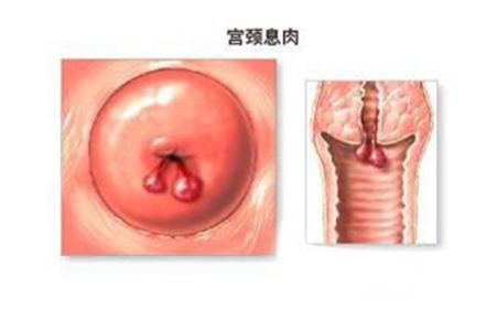 苏州治疗宫颈息肉医院