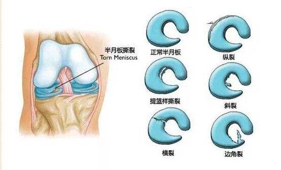 苏州治疗半月板损伤医院