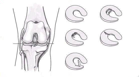 苏州治疗半月板损伤医院