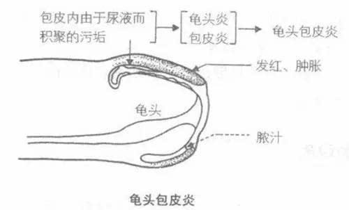 苏州治疗龟头炎贵吗